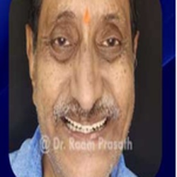 Smile Makeover in Teynampet